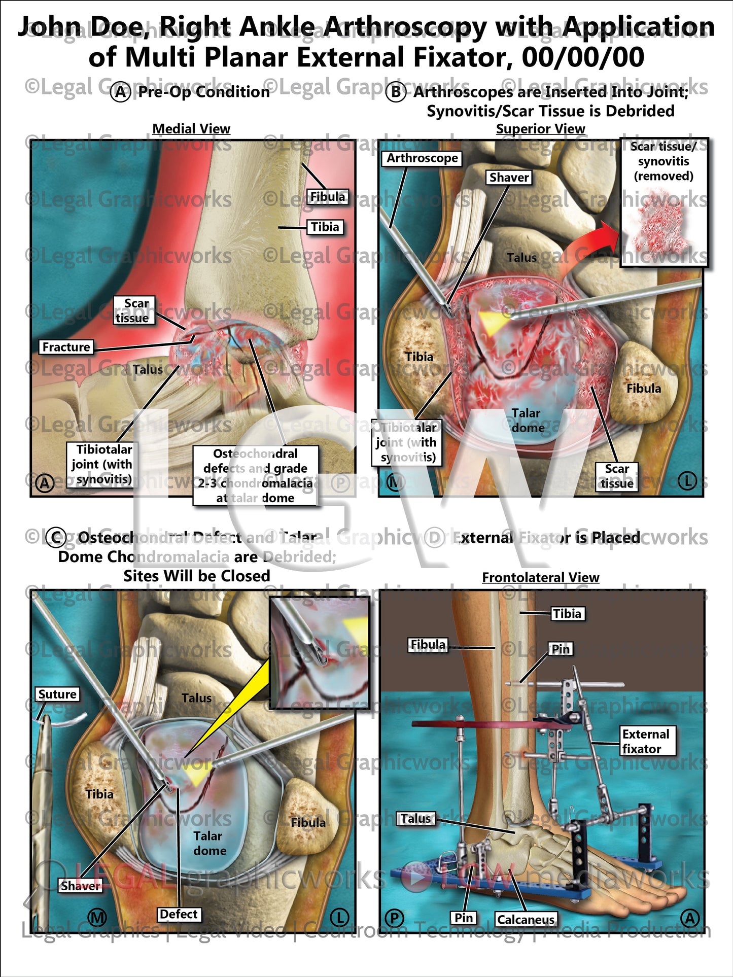 Right Ankle Arthroscopy with Application of Multi Planar External Fixator