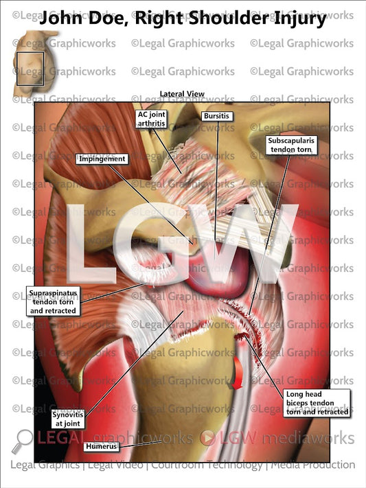 Right Shoulder Injury
