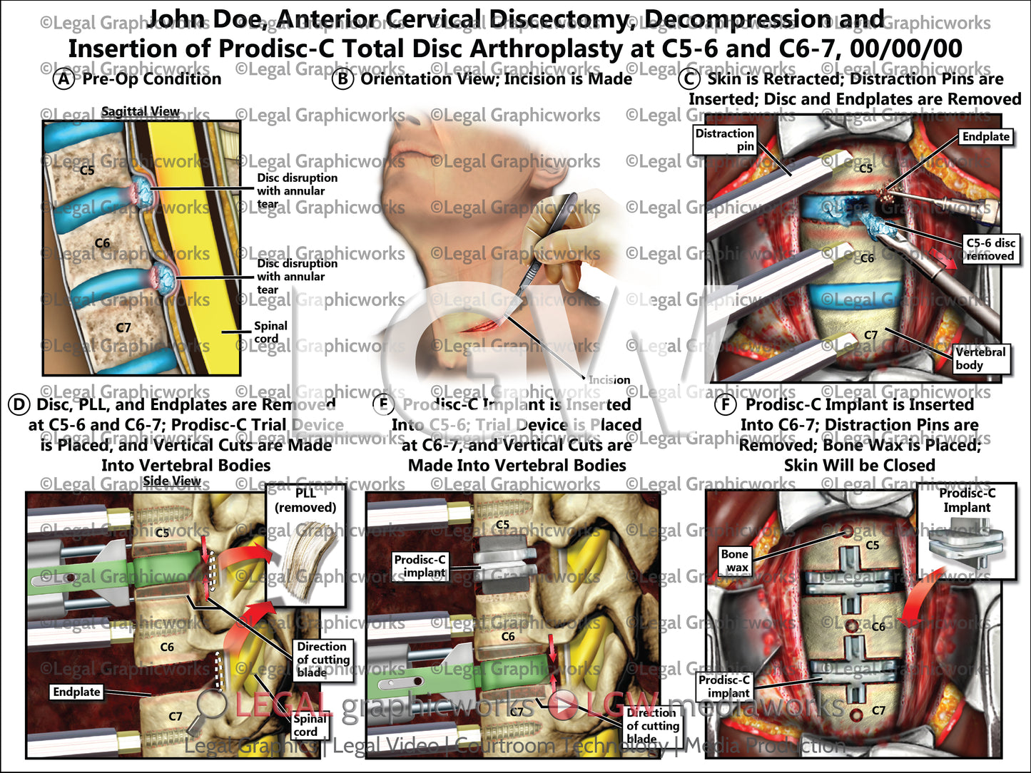 Anterior Cervical Discectomy, Decompression and Insertion of Prodisc-C Total Disc Arthroplasty at C5-6 and C6-7