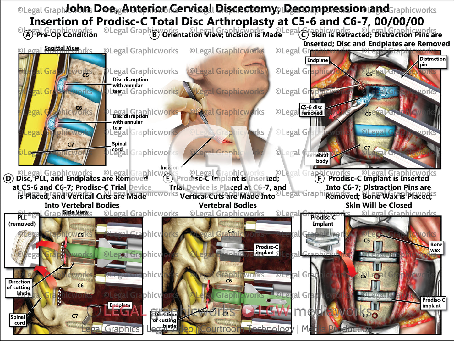 Anterior Cervical Discectomy, Decompression and Insertion of Prodisc-C Total Disc Arthroplasty at C5-6 and C6-7