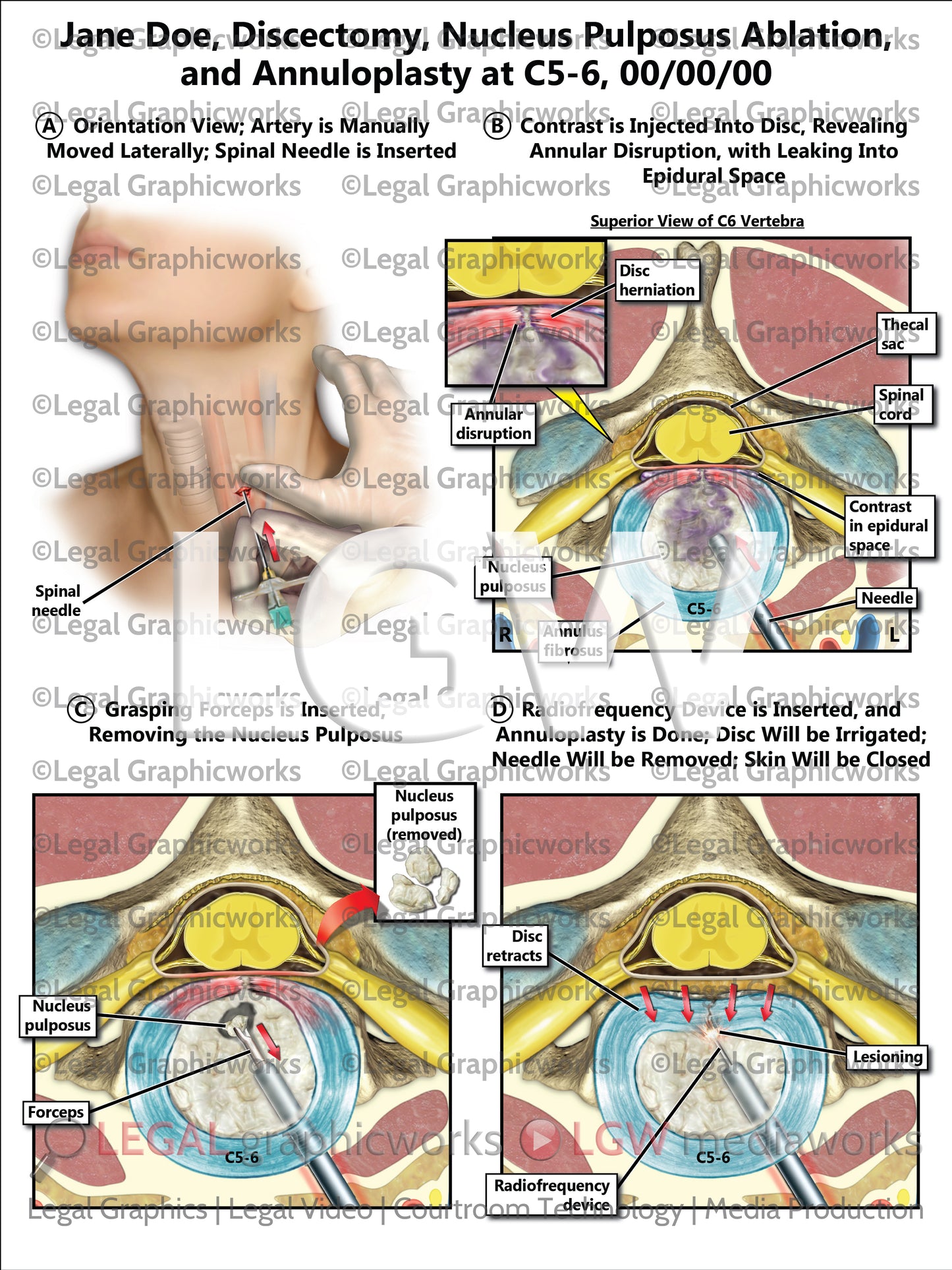 Discectomy, Nucleus Pulposus Ablation, and Annuloplasty at C5-6