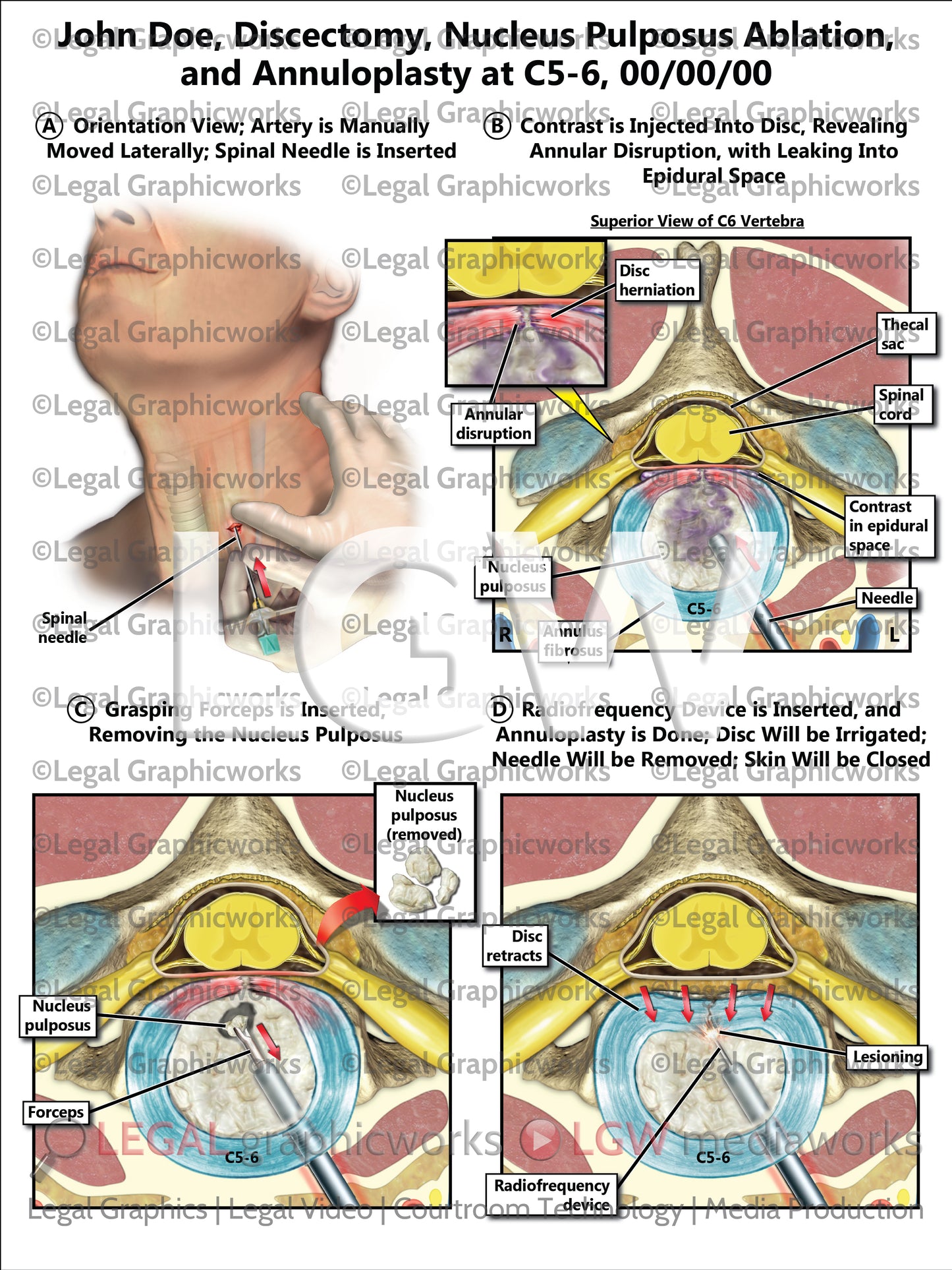 Discectomy, Nucleus Pulposus Ablation, and Annuloplasty at C5-6