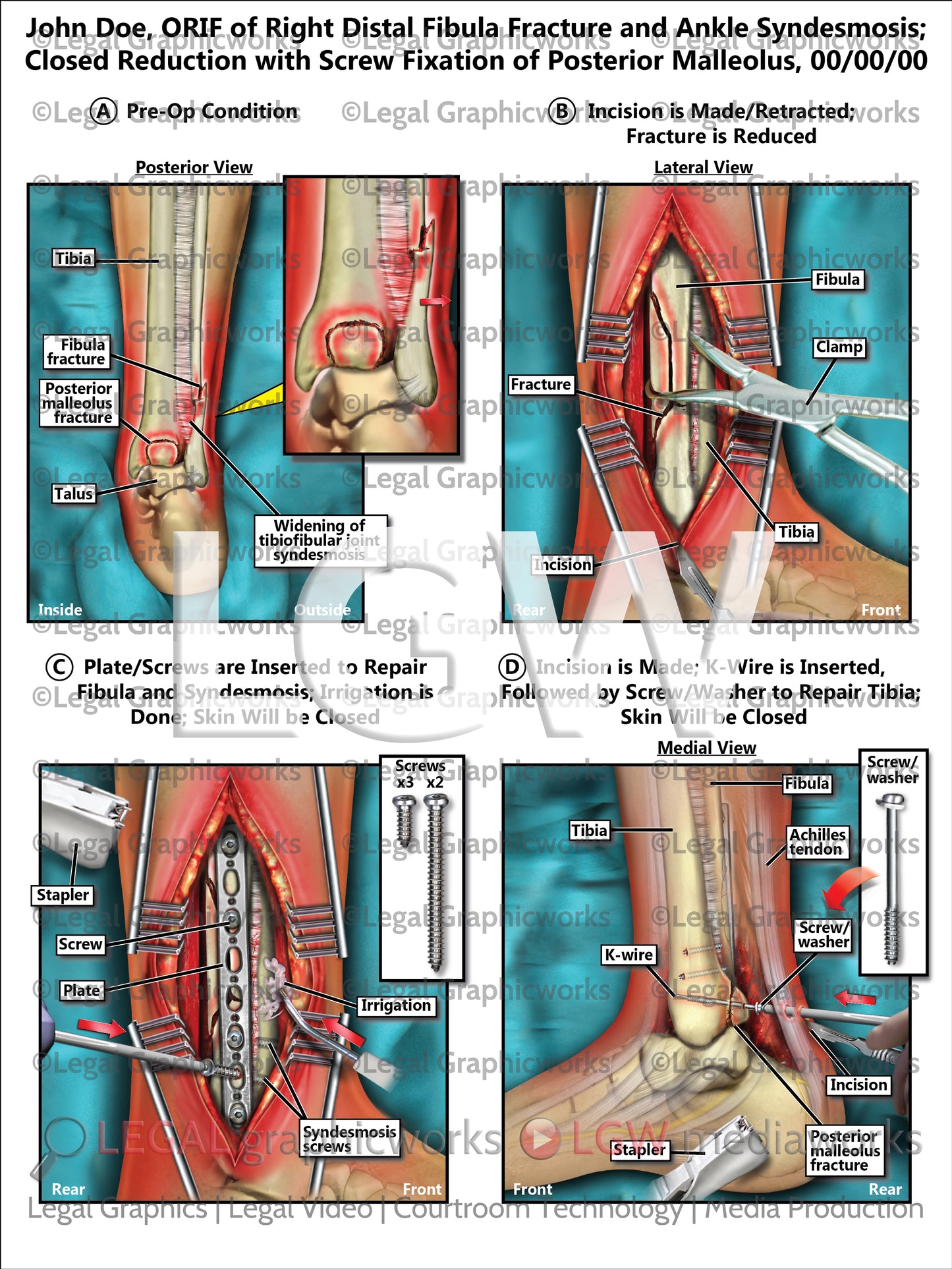 ORIF of Right Distal Fibula Fracture and Ankle Syndesmosis; Closed Reduction with Screw Fixation of Posterior Malleolus