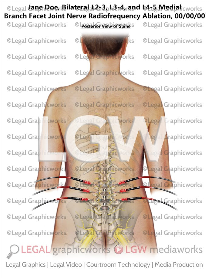Bilateral L2-3, L3-4, and L4-5 Medial Branch Facet Joint Nerve Radiofrequency Ablation