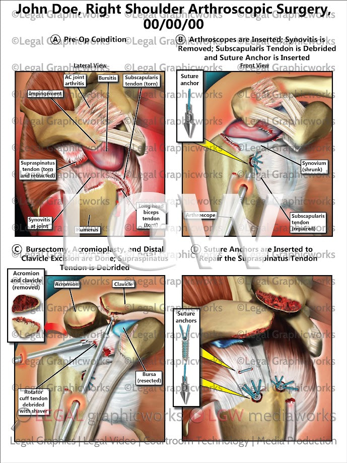 Right Shoulder Arthroscopic Surgery
