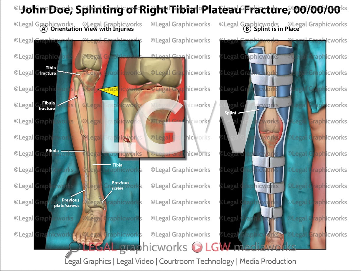 Splinting of Right Tibial Plateau Fracture