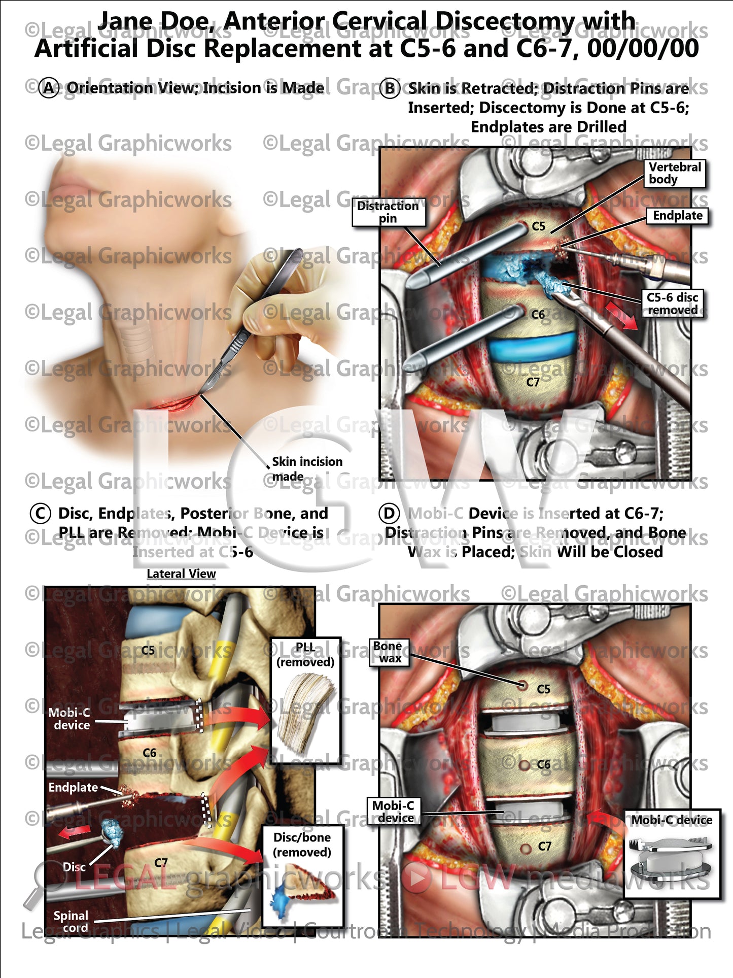 Anterior Cervical Discectomy with Artificial Disc Replacement at C5-6 and C6-7