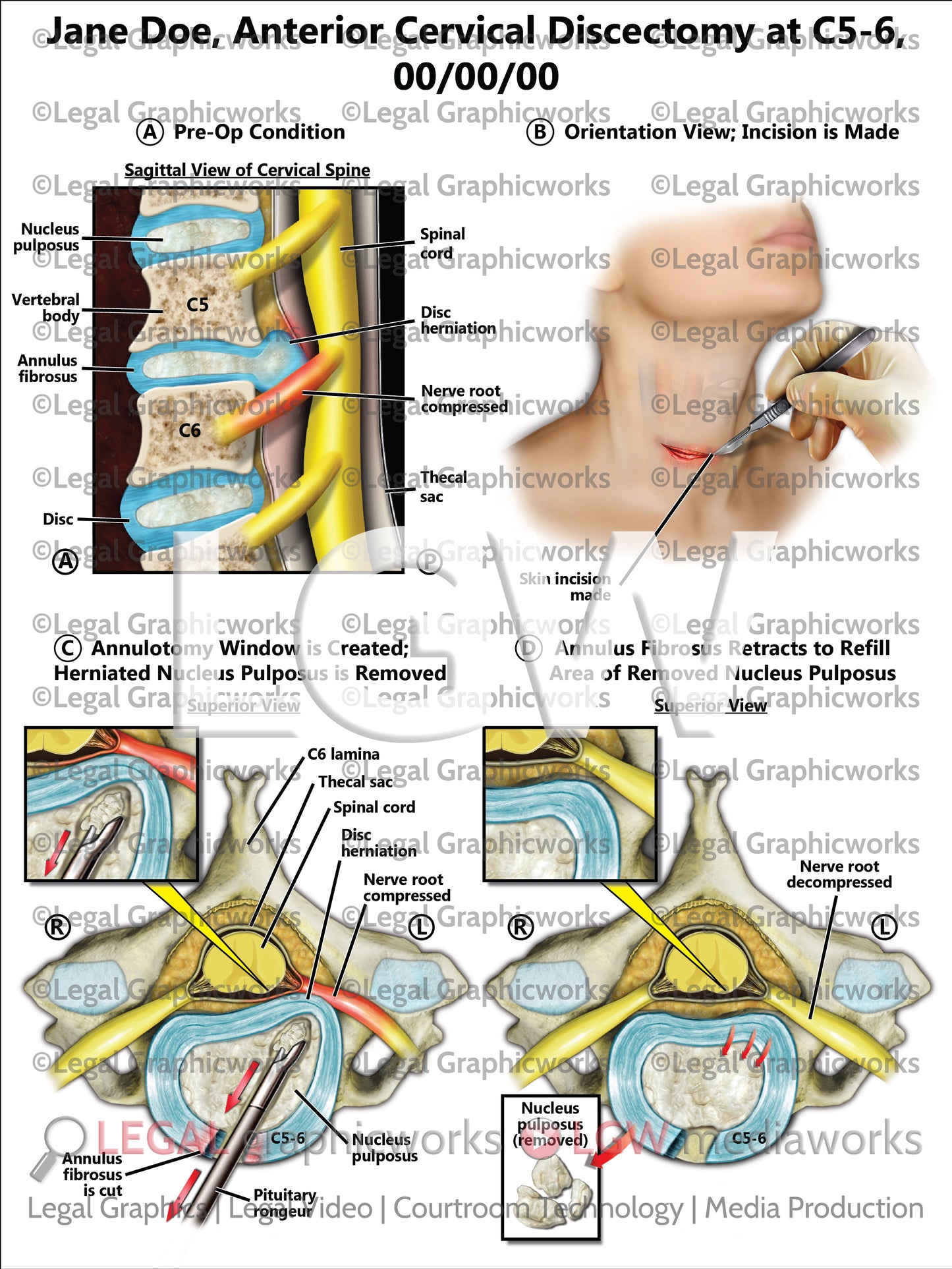 Anterior Cervical Discectomy at C5-6