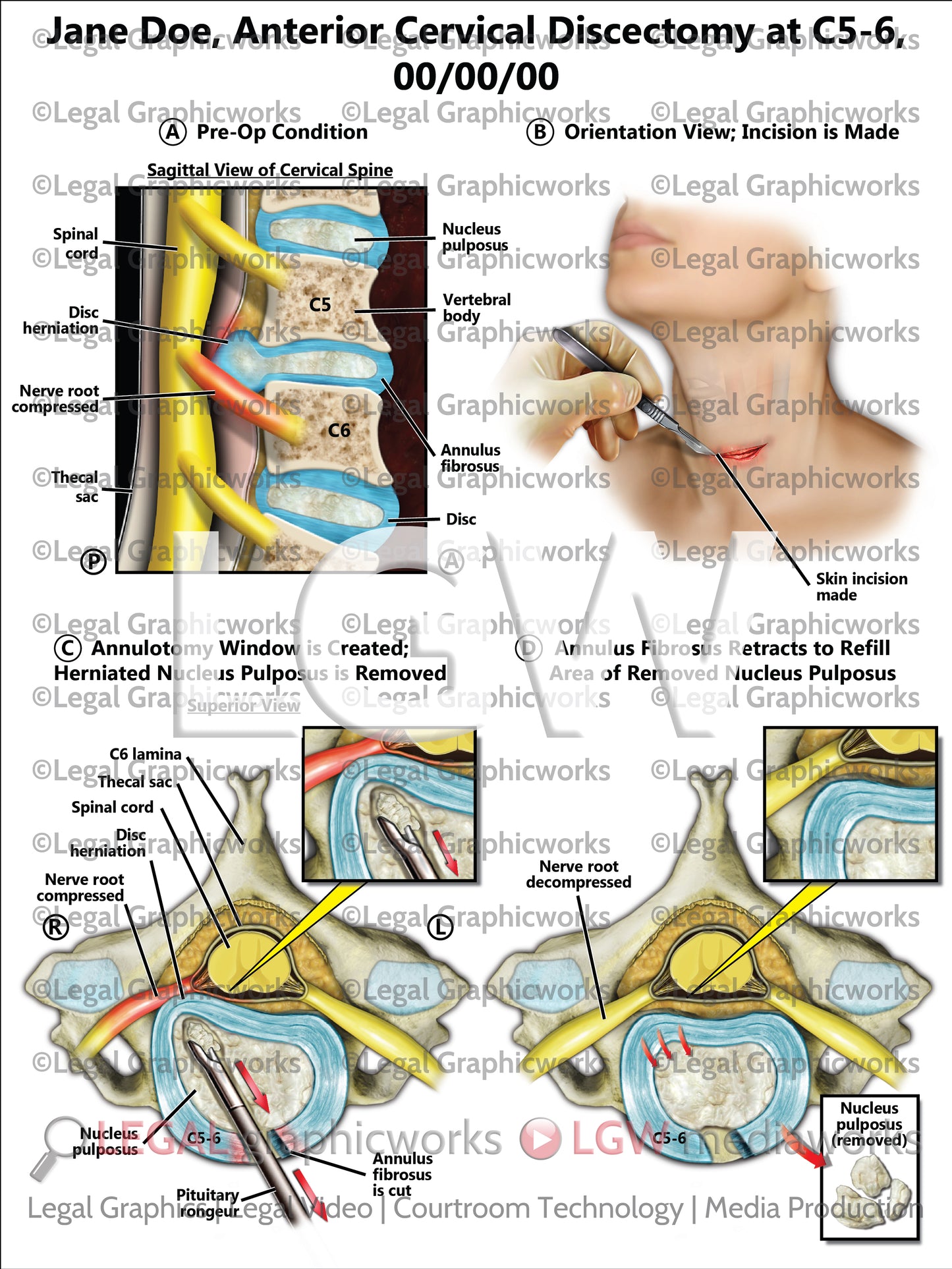 Anterior Cervical Discectomy at C5-6
