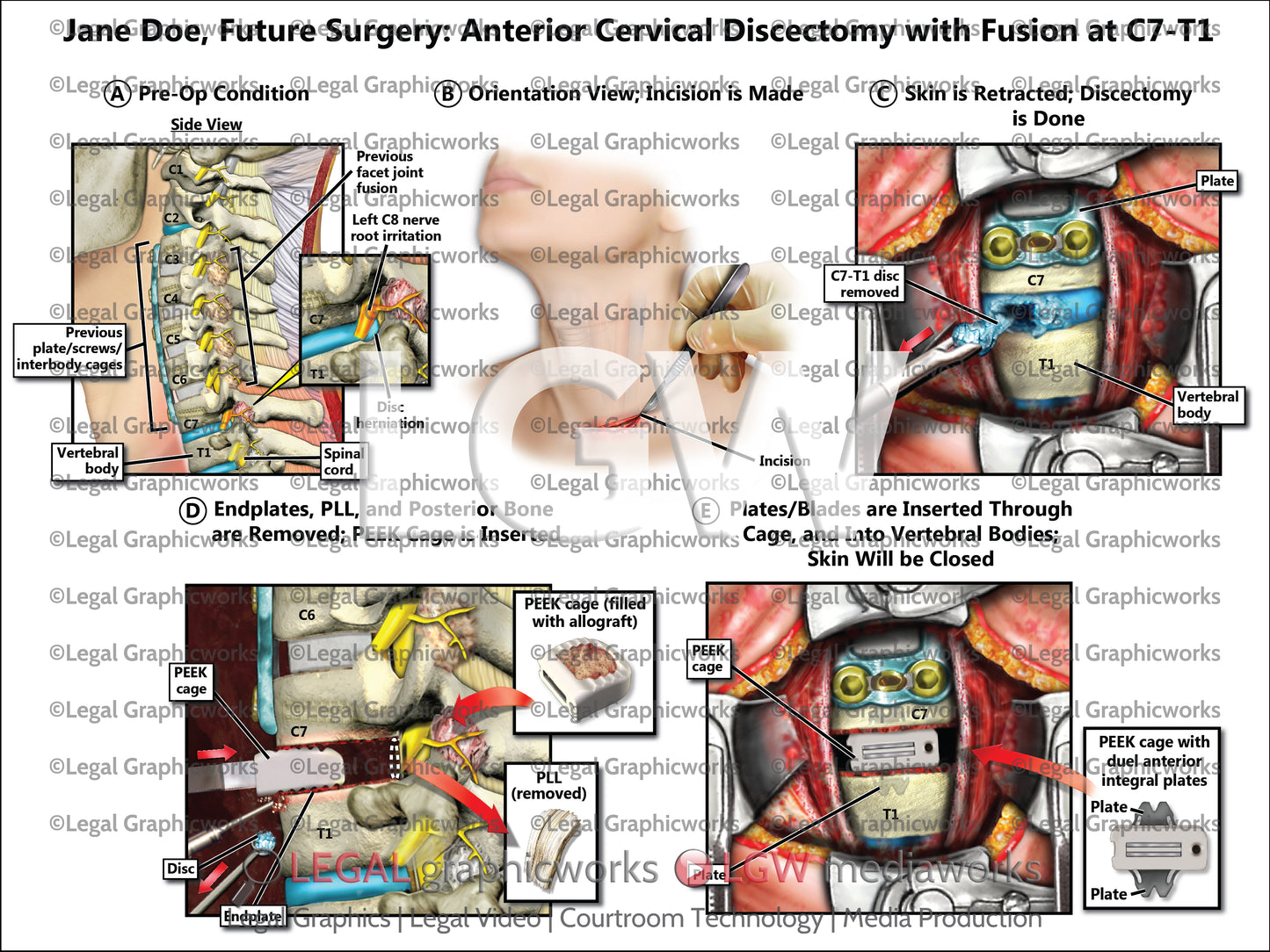 Future Surgery: Anterior Cervical Discectomy with Fusion at C7-T1