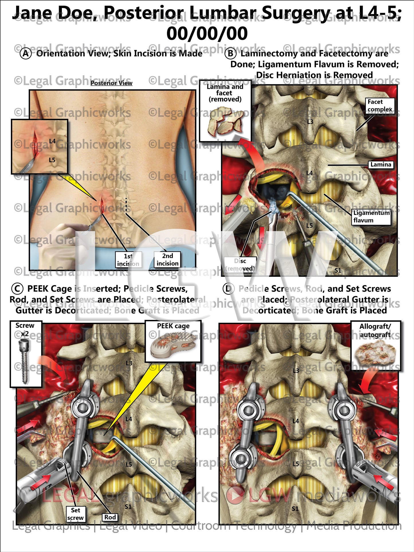 Posterior Lumbar Surgery at L4-5