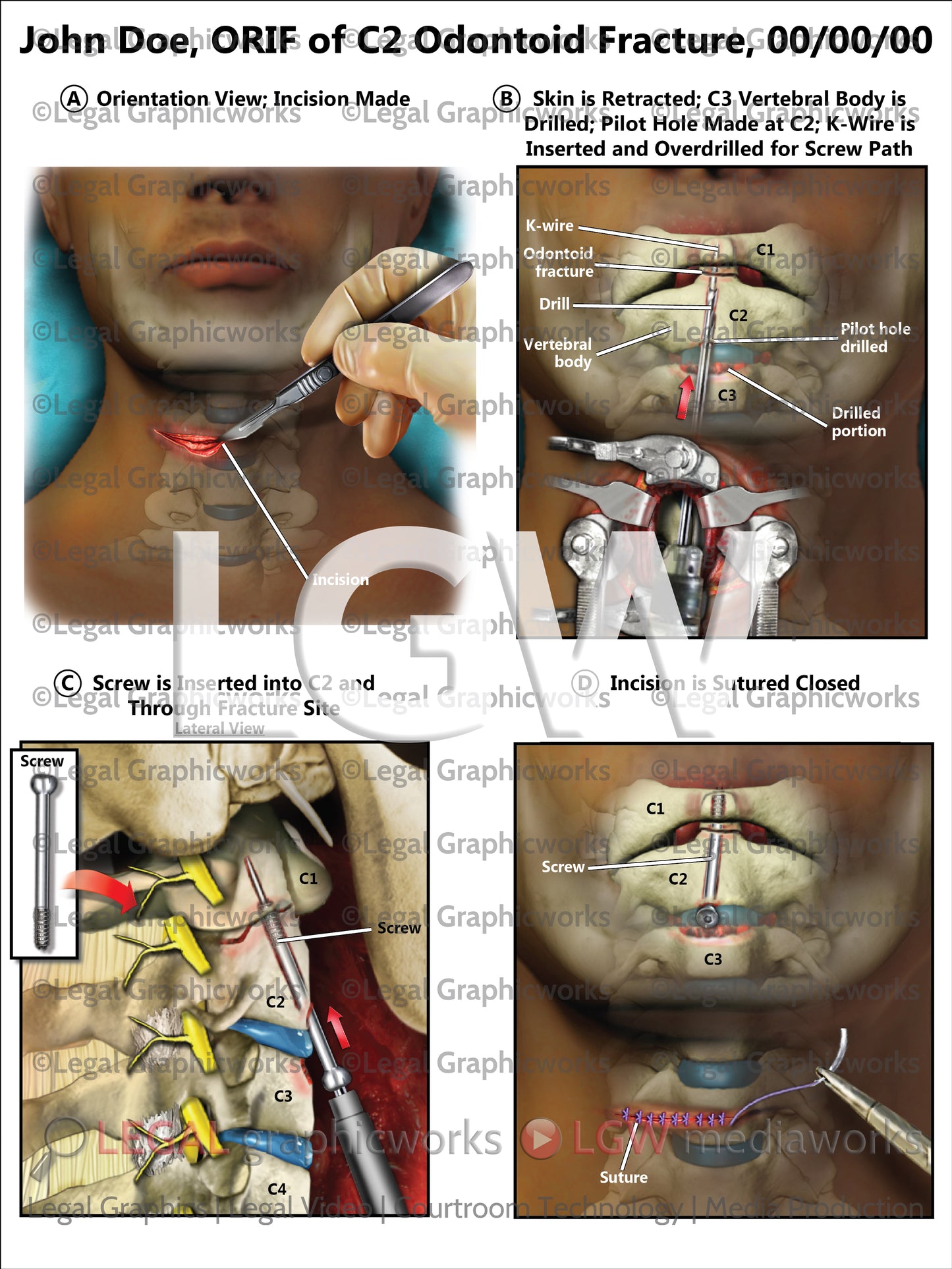 ORIF of C2 Odontoid Fracture