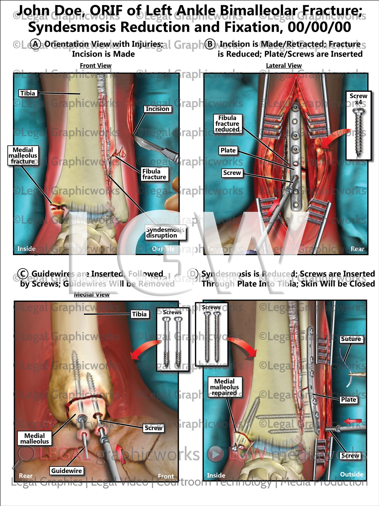 ORIF of Left Ankle Bimalleolar Fracture; Syndesmosis Reduction and Fixation