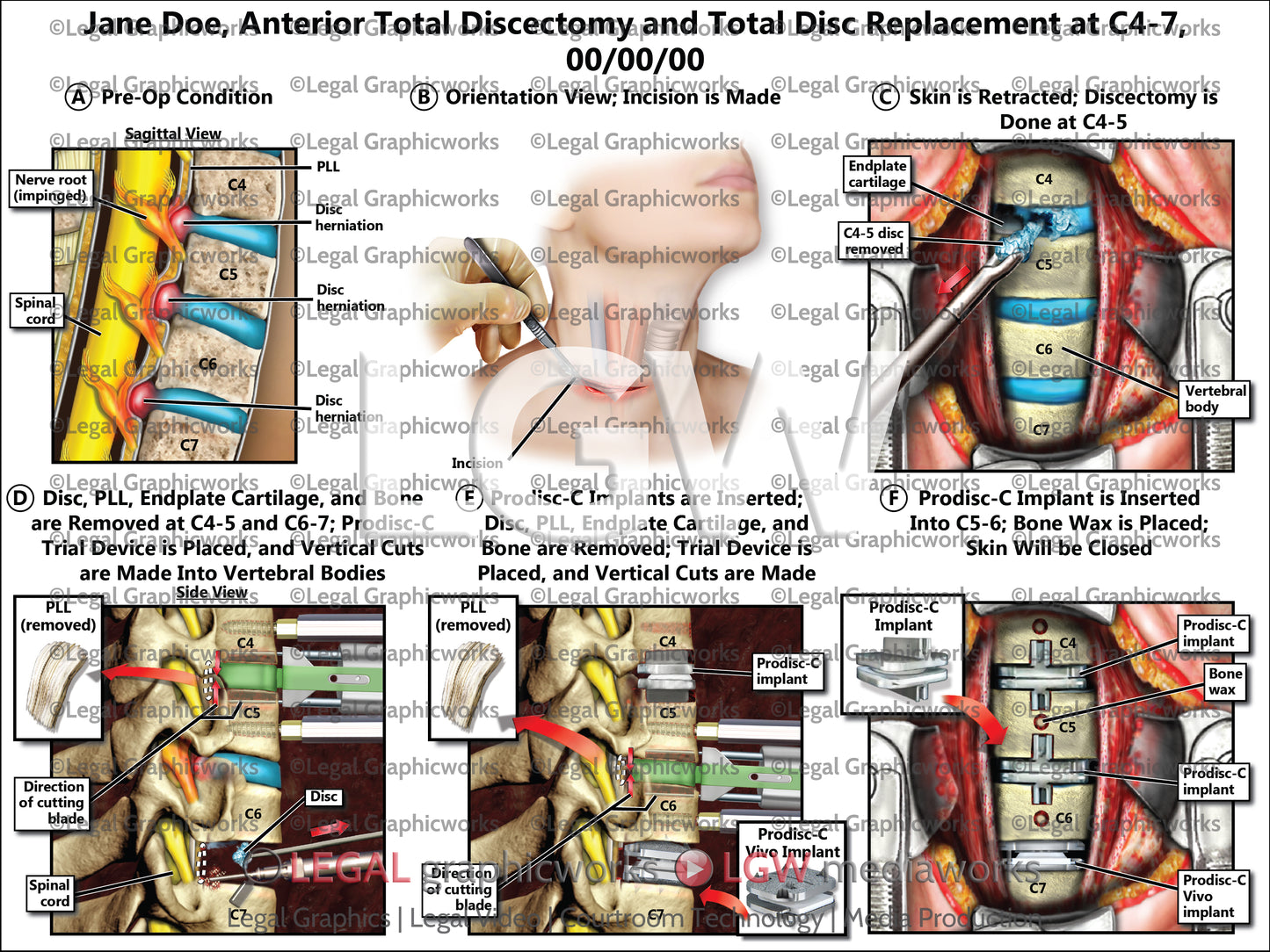 Anterior Total Discectomy and Total Disc Replacement at C4-7