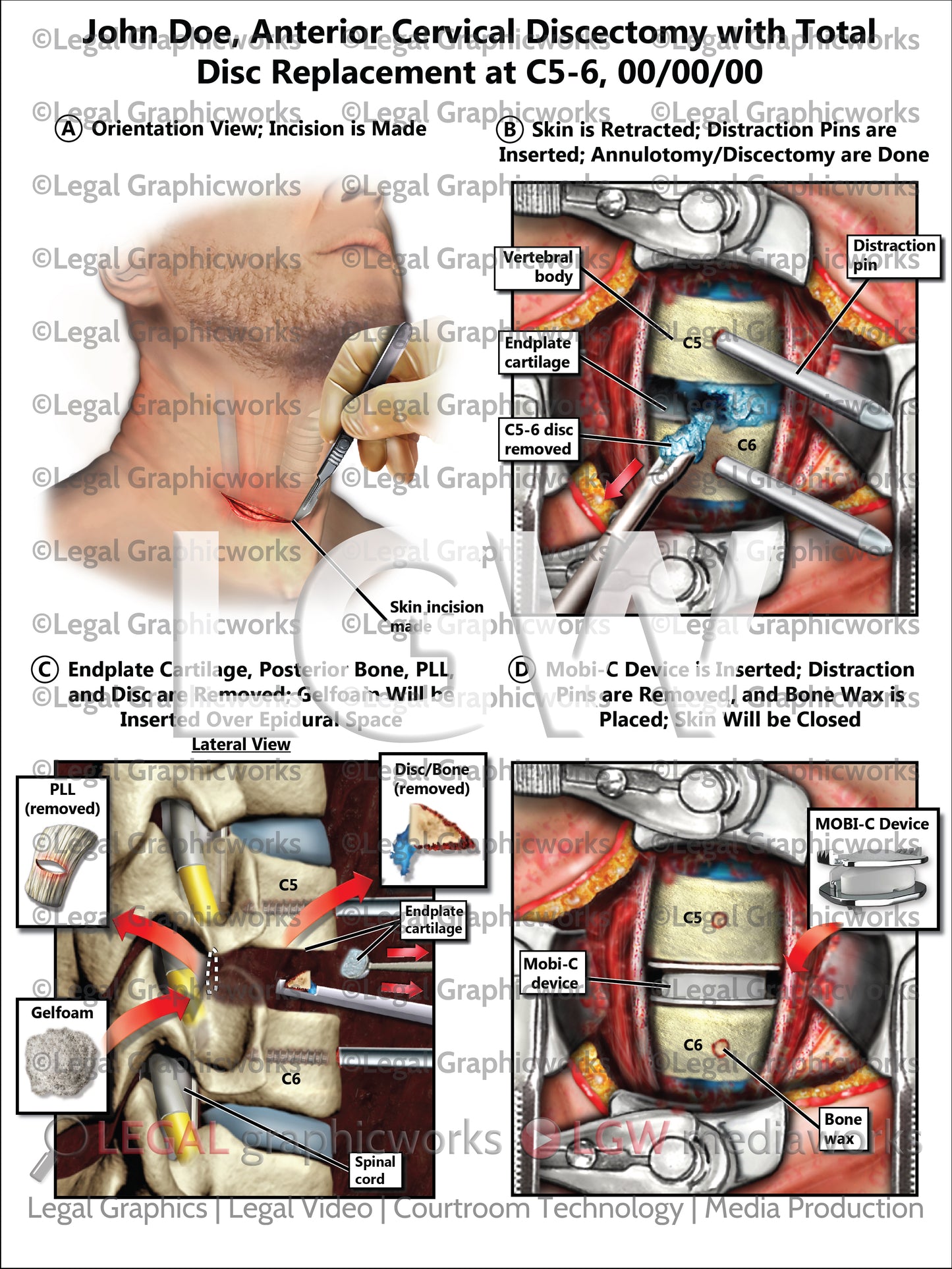 Anterior Cervical Discectomy with Total Disc Replacement at C5-6