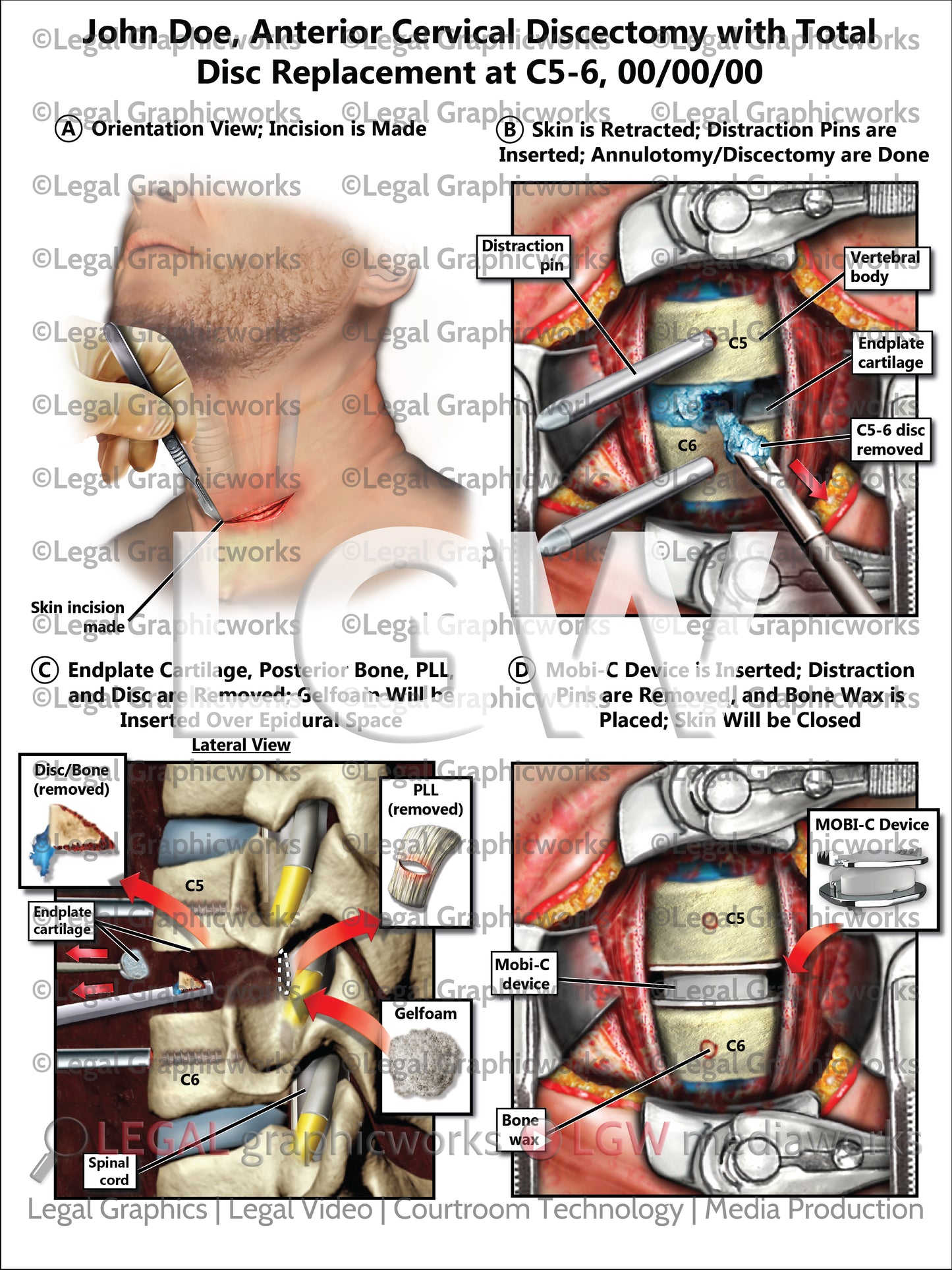 Anterior Cervical Discectomy with Total Disc Replacement at C5-6