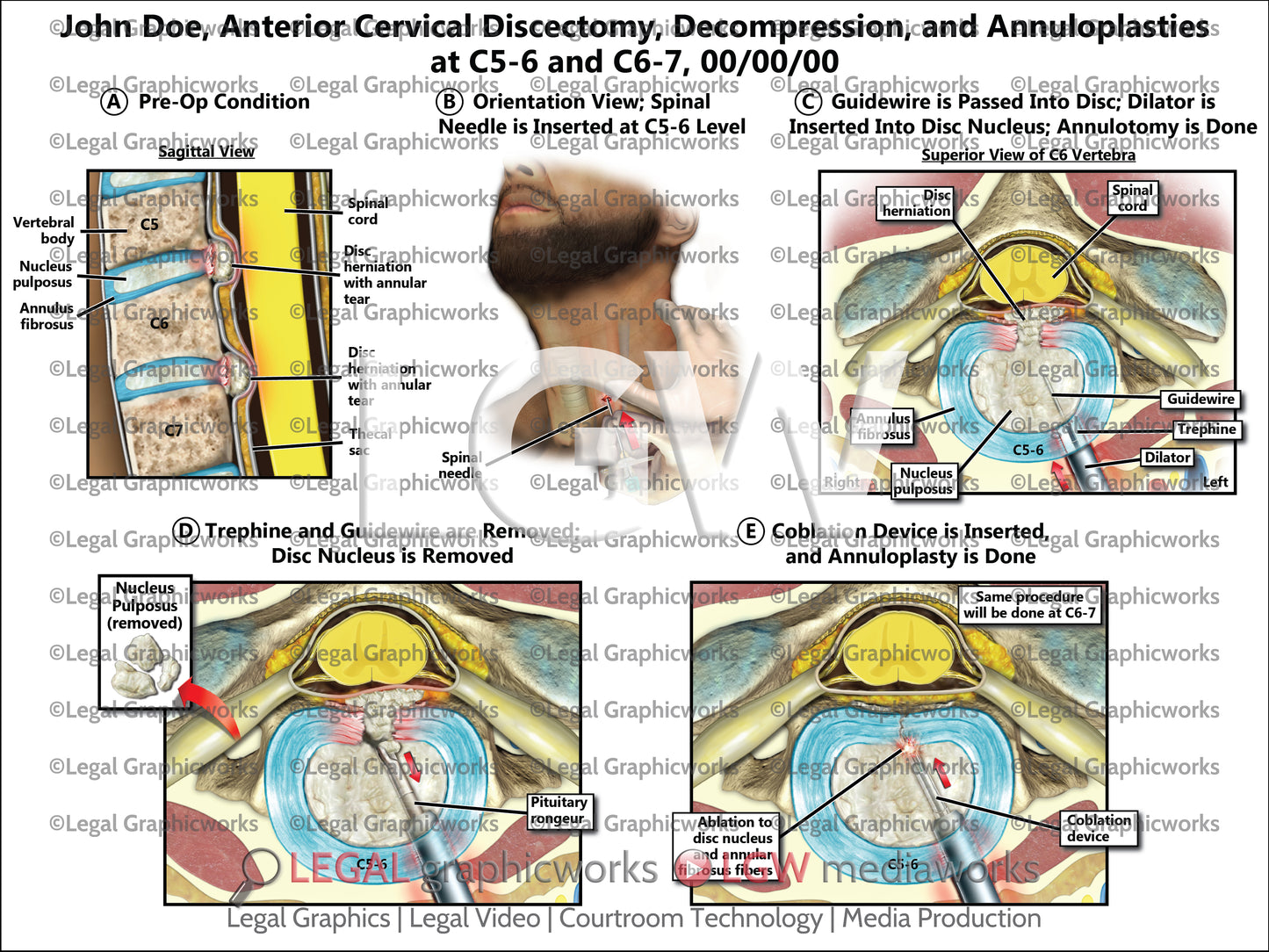 Anterior Cervical Discectomy, Decompression, and Annuloplasties at C5-6 and C6-7