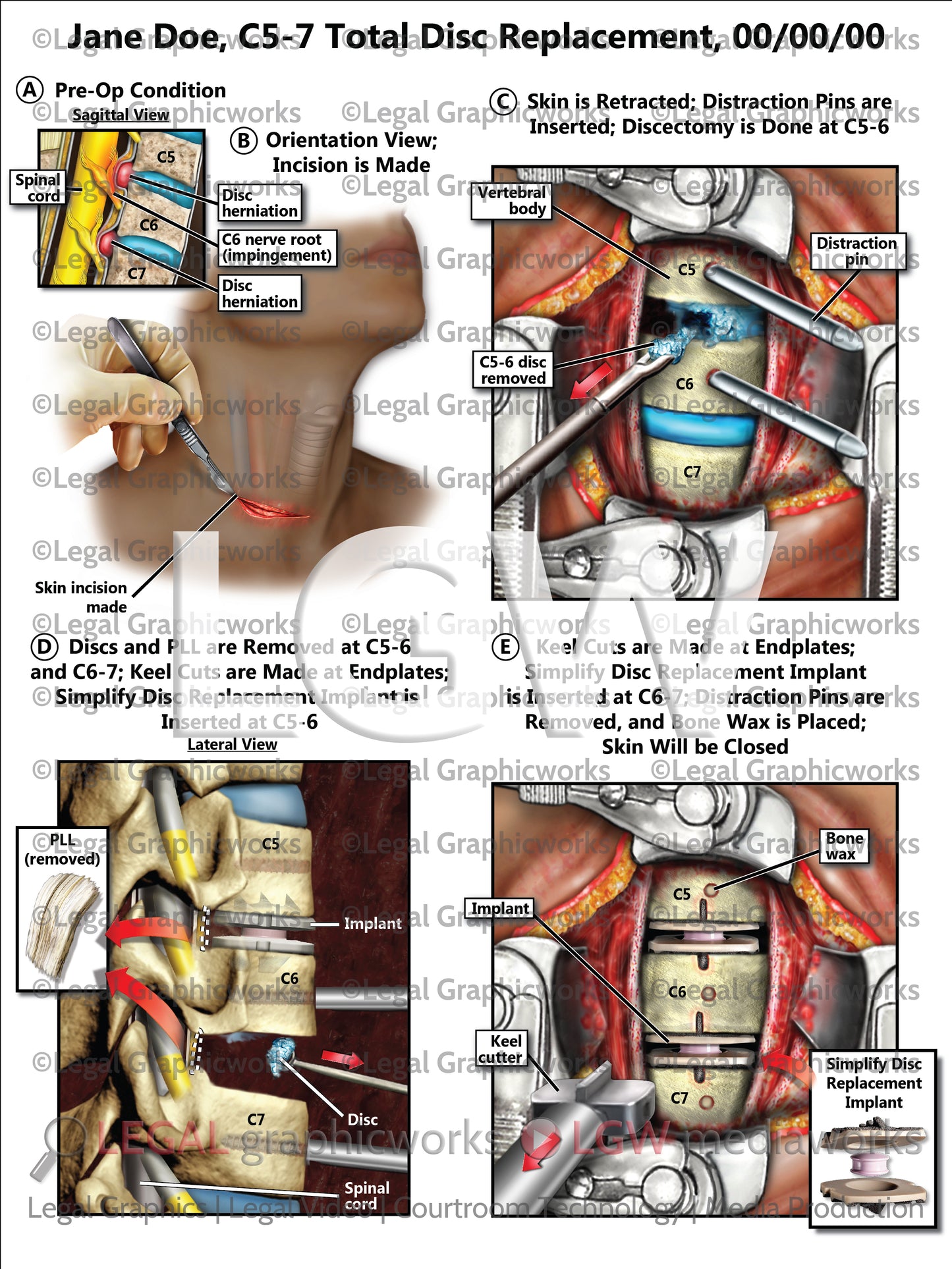 C5-7 Total Disc Replacement