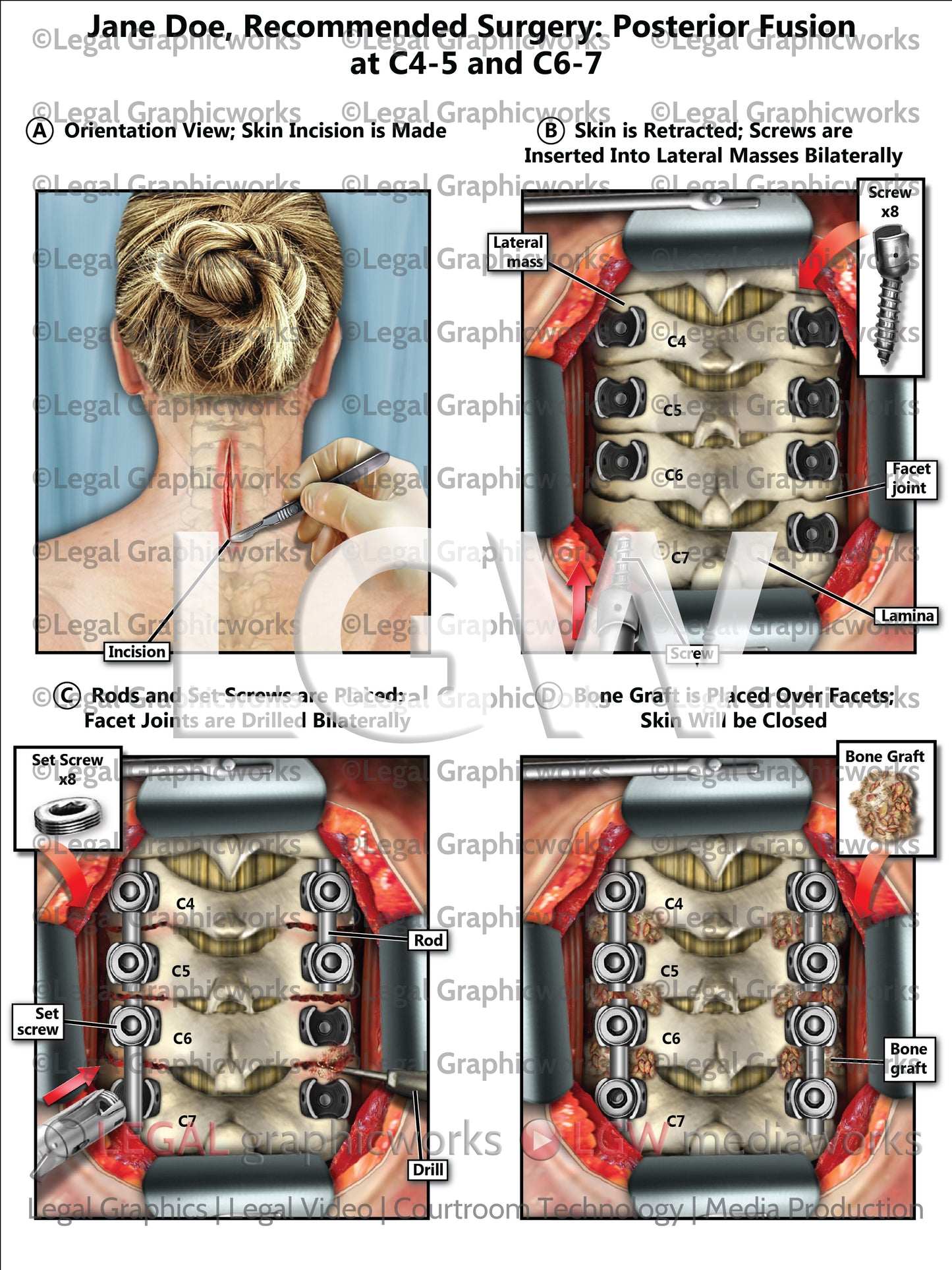 Recommended Surgery: Posterior Fusion at C4-5 and C6-7