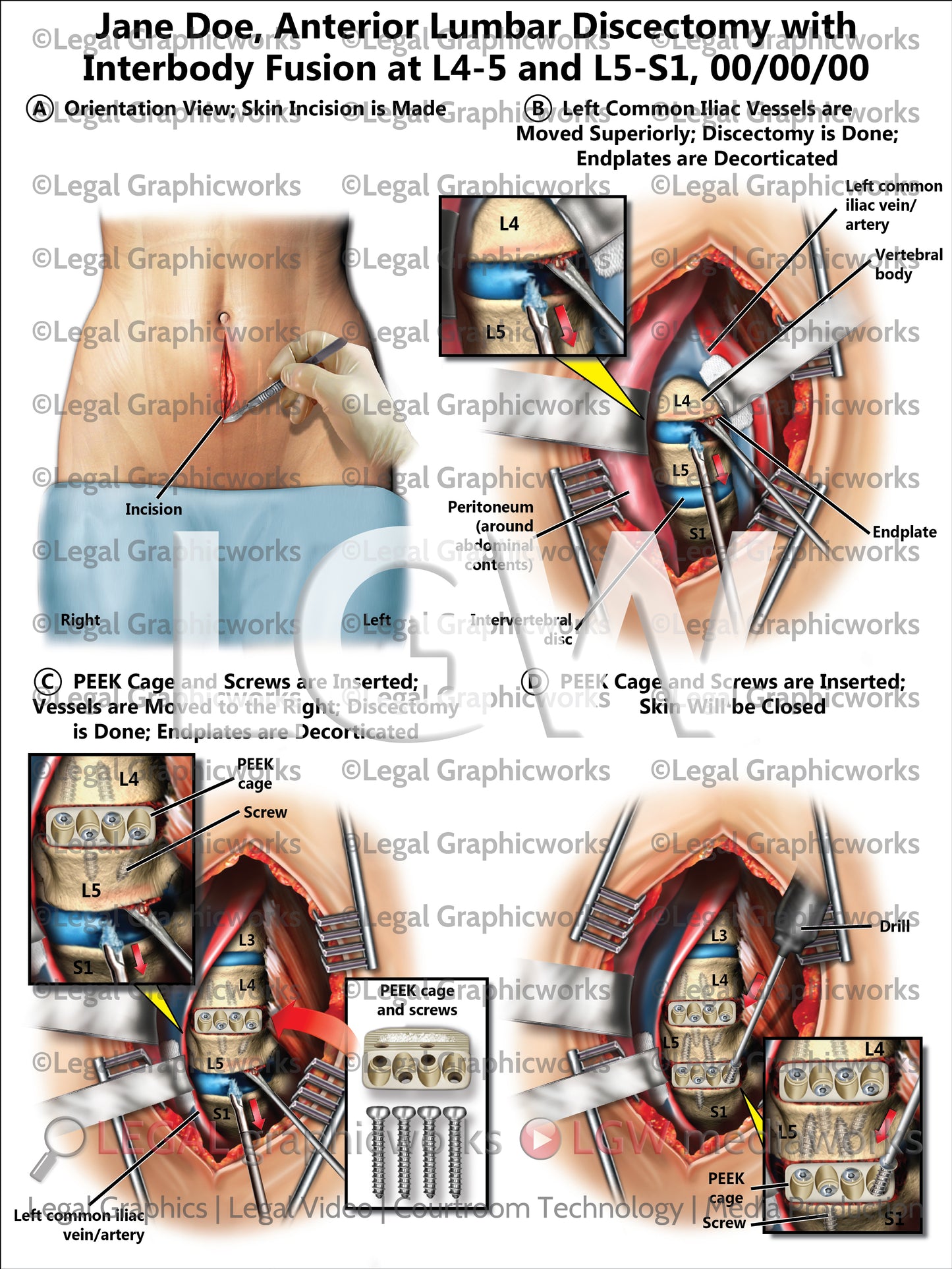 Anterior Lumbar Discectomy with Interbody Fusion at L4-5 and L5-S1