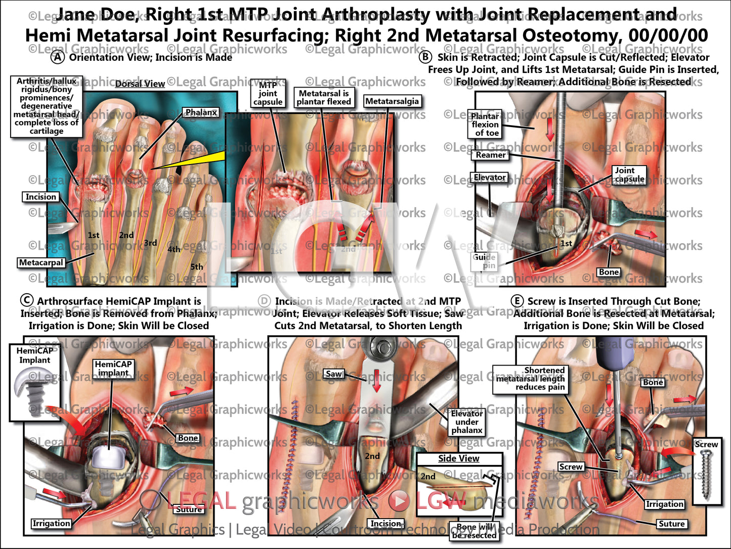 Right 1st MTP Joint Arthroplasty with Joint Replacement and Hemi Metatarsal Joint Resurfacing; Right 2nd Metatarsal Osteotomy