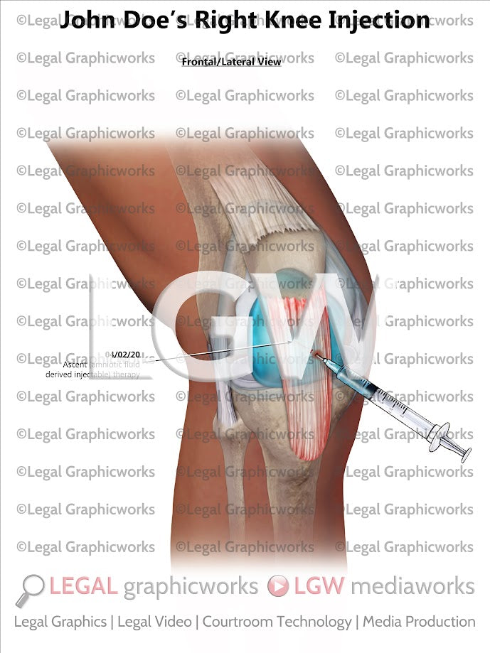 Right Knee Injection