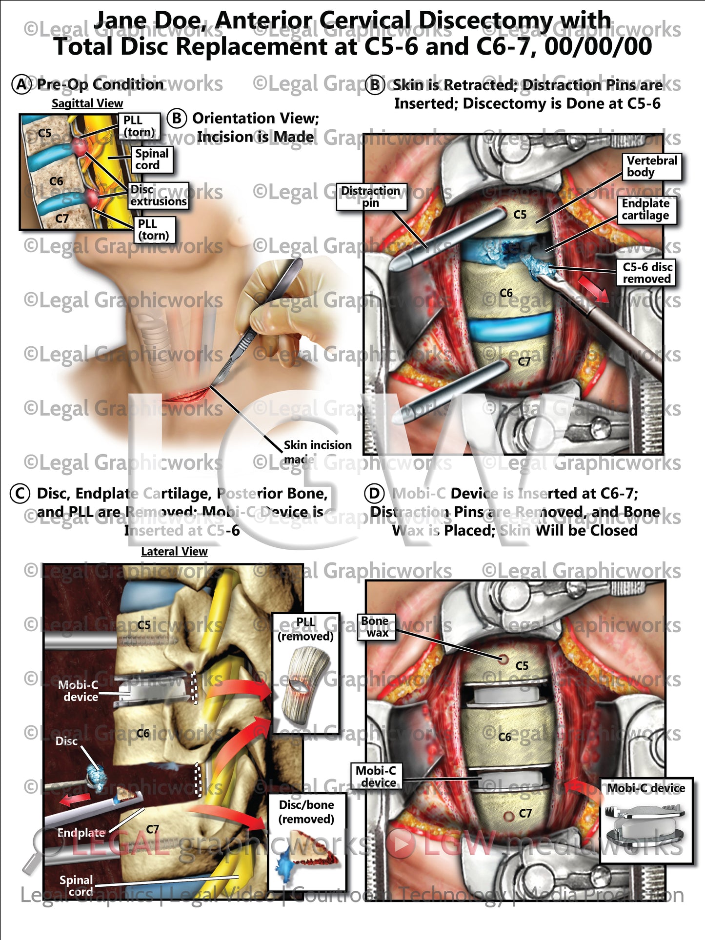 Anterior Cervical Discectomy with Total Disc Replacement at C5-6 and C6-7