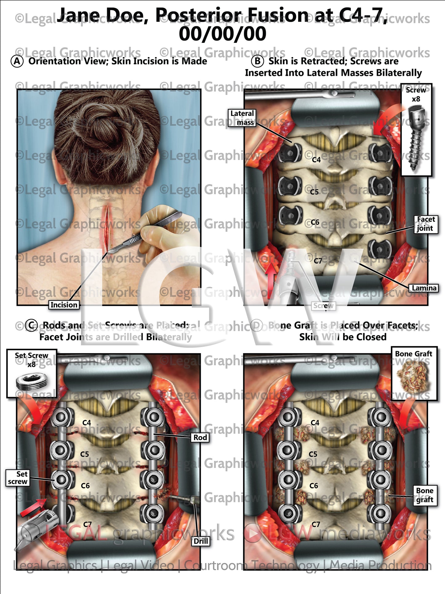 Posterior Fusion at C4-7