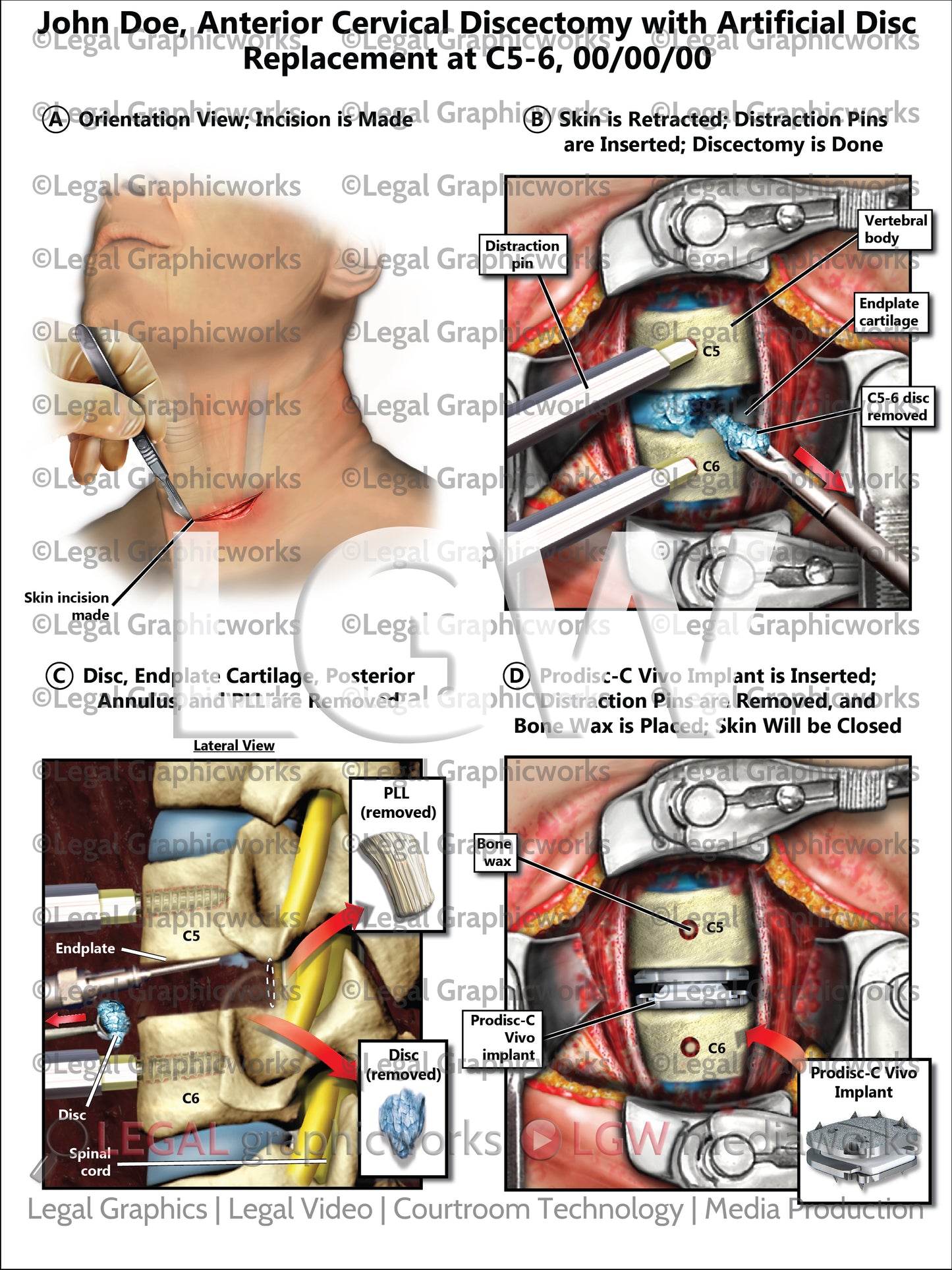 Anterior Cervical Discectomy with Artificial Disc Replacement at C5-6