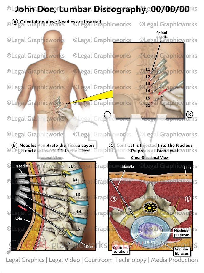 Lumbar Discography