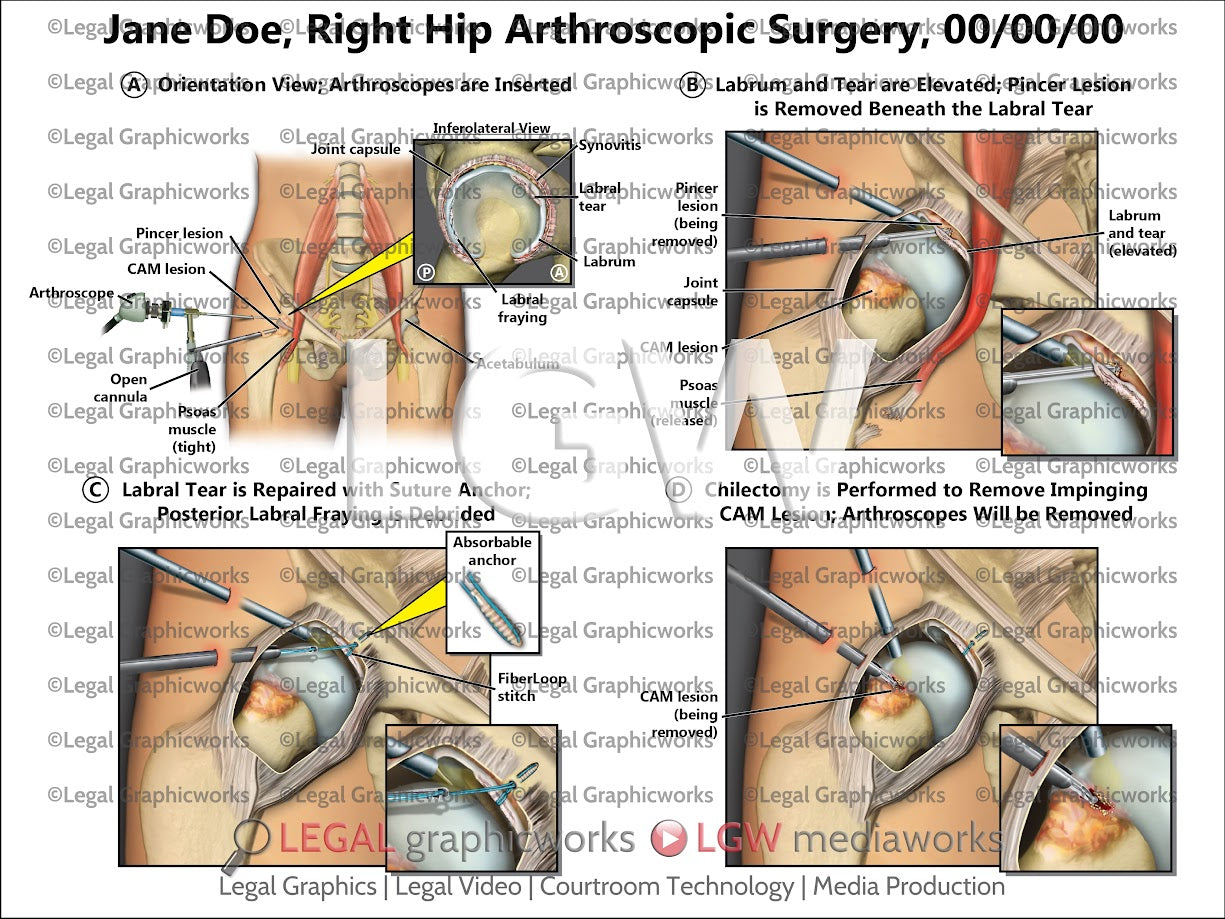 Right Hip Arthroscopic Surgery