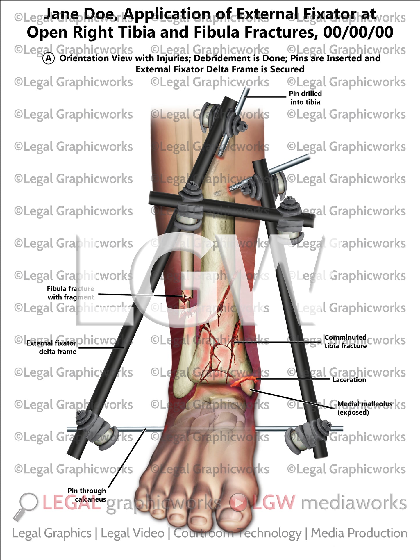 Application of External Fixator at Open Right Tibia and Fibula Fractures
