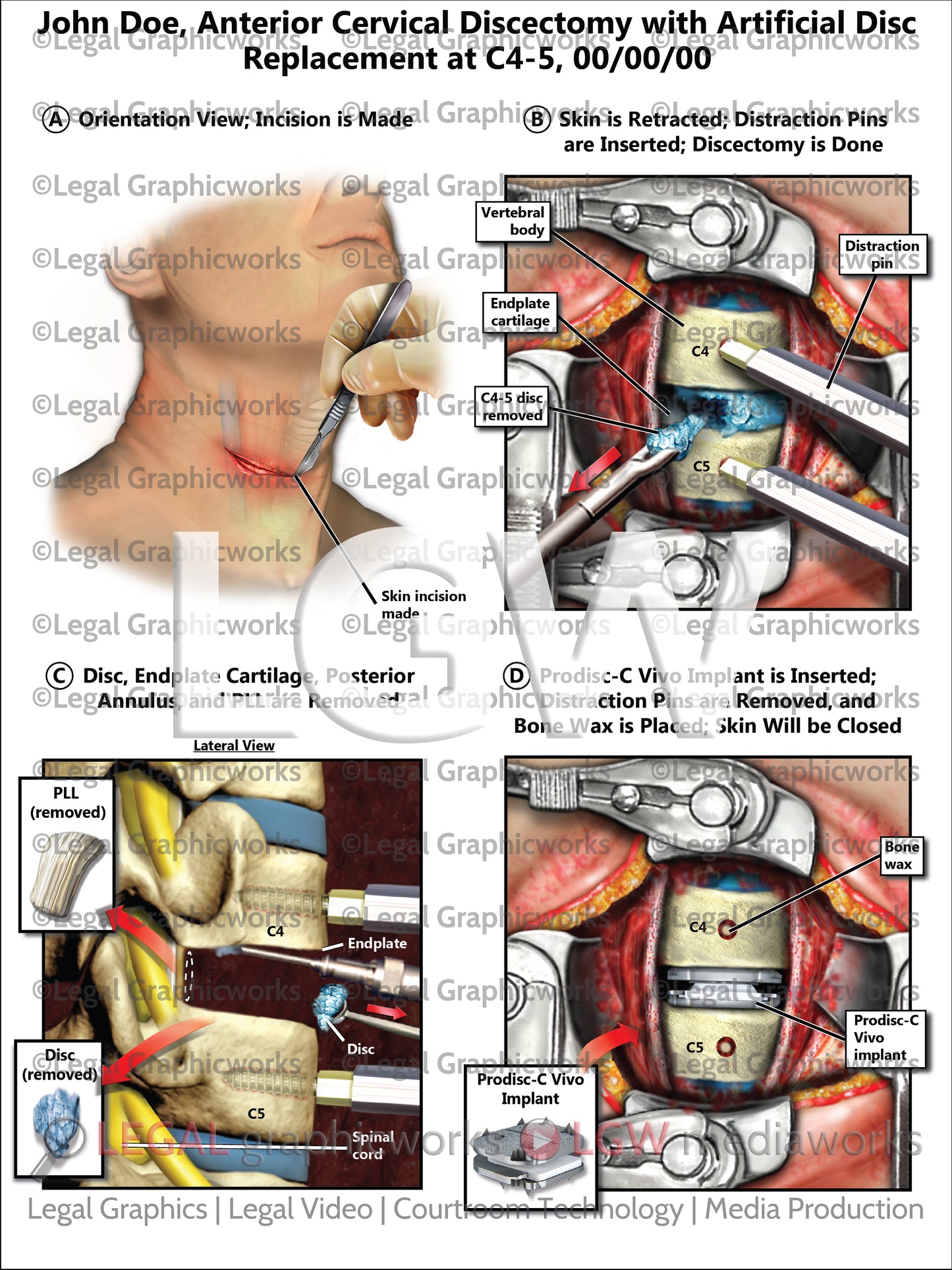 Anterior Cervical Discectomy with Artificial Disc Replacement at C4-5