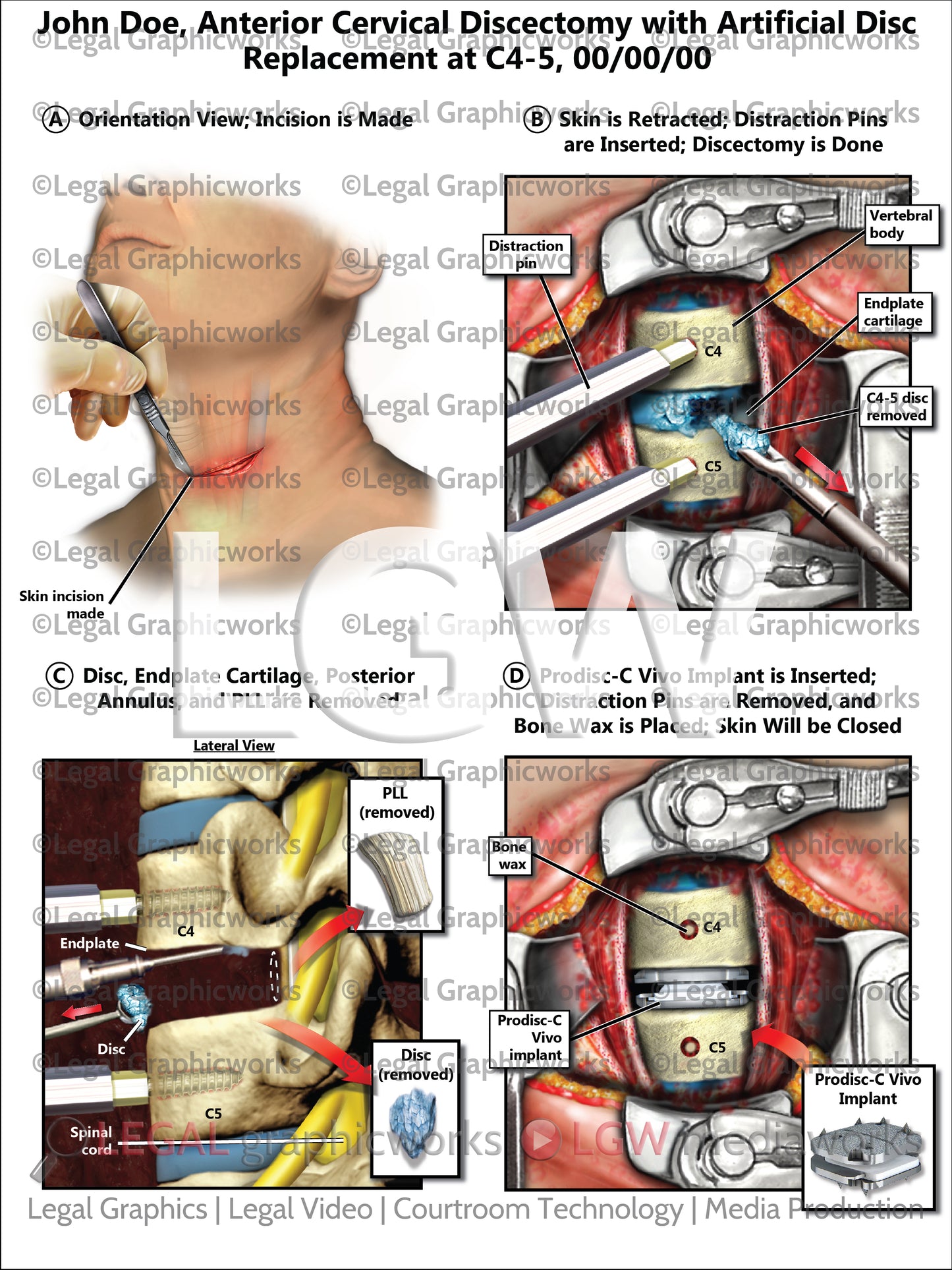 Anterior Cervical Discectomy with Artificial Disc Replacement at C4-5