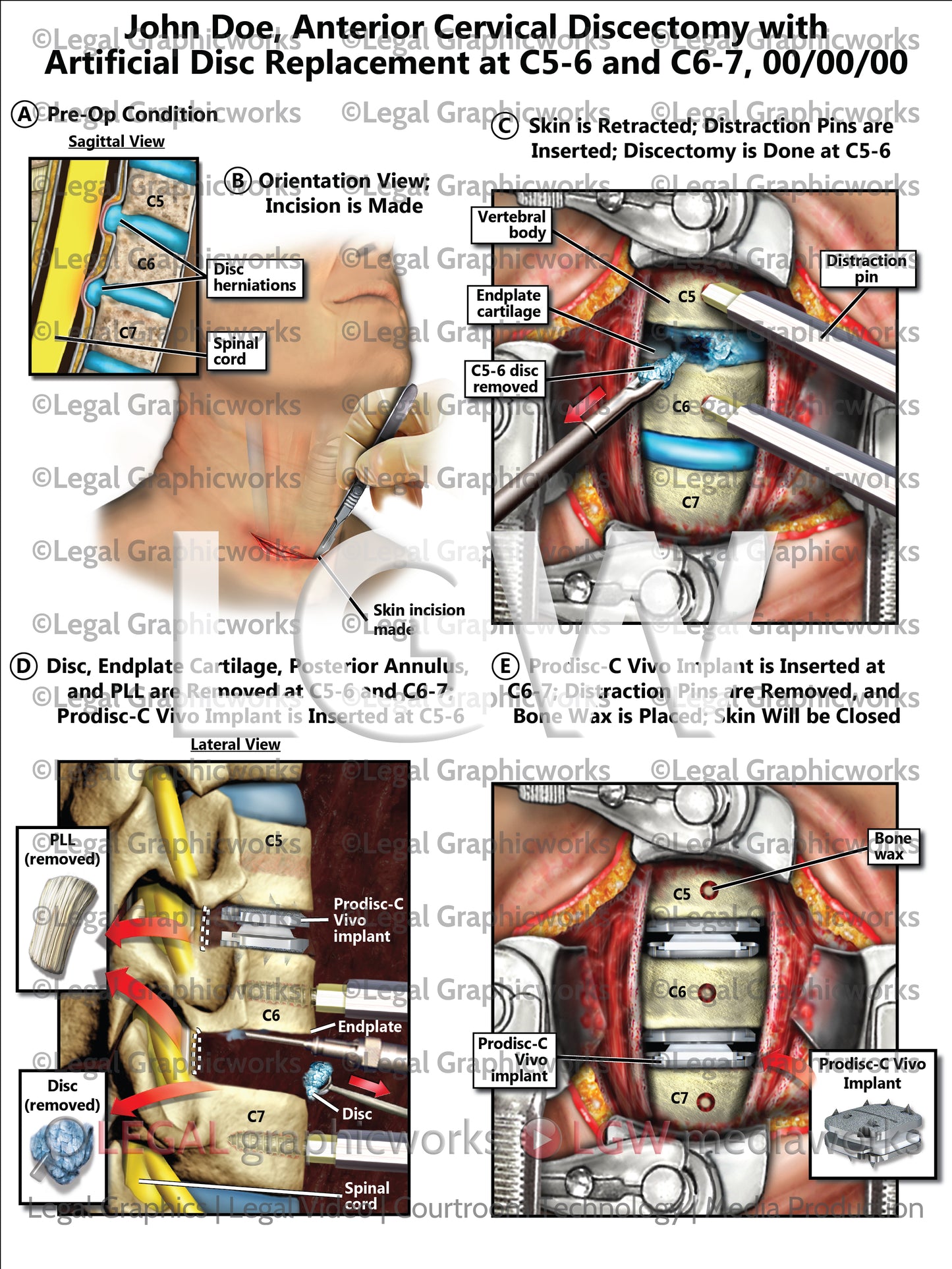 Anterior Cervical Discectomy with Artificial Disc Replacement at C5-6 and C6-7