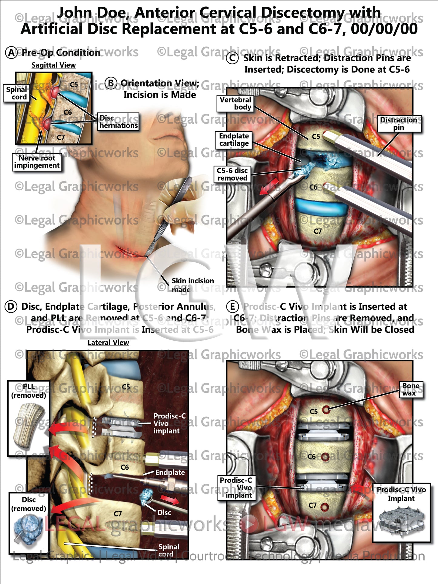 Anterior Cervical Discectomy with Artificial Disc Replacement at C5-6 and C6-7