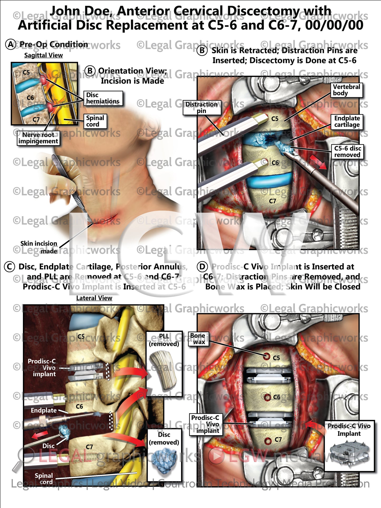 Anterior Cervical Discectomy with Artificial Disc Replacement at C5-6 and C6-7