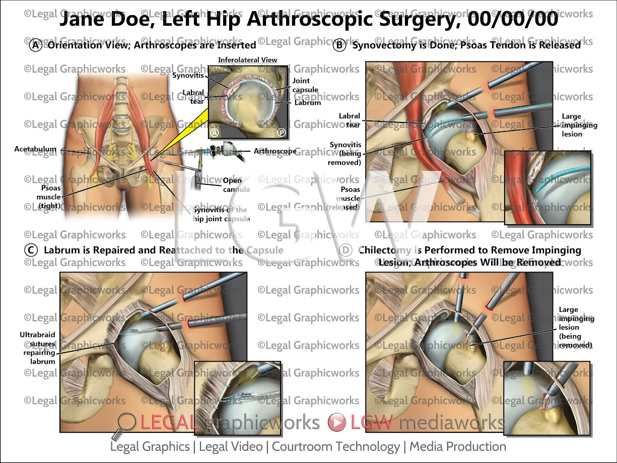 Left Hip Arthroscopic Surgery