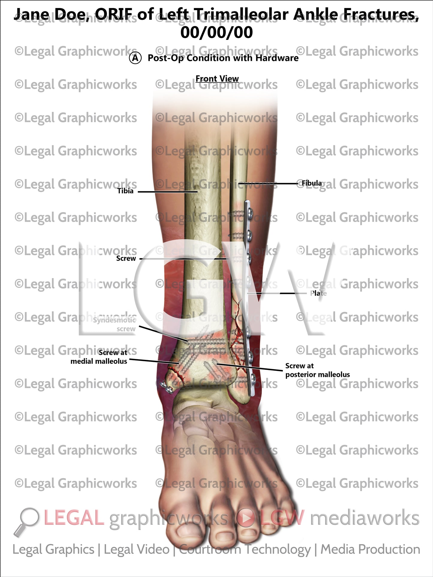 ORIF of Left Trimalleolar Ankle Fractures
