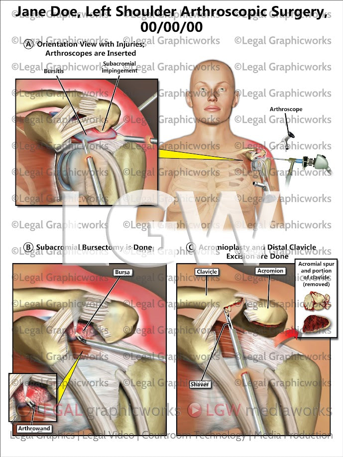 Left Shoulder Arthroscopic Surgery
