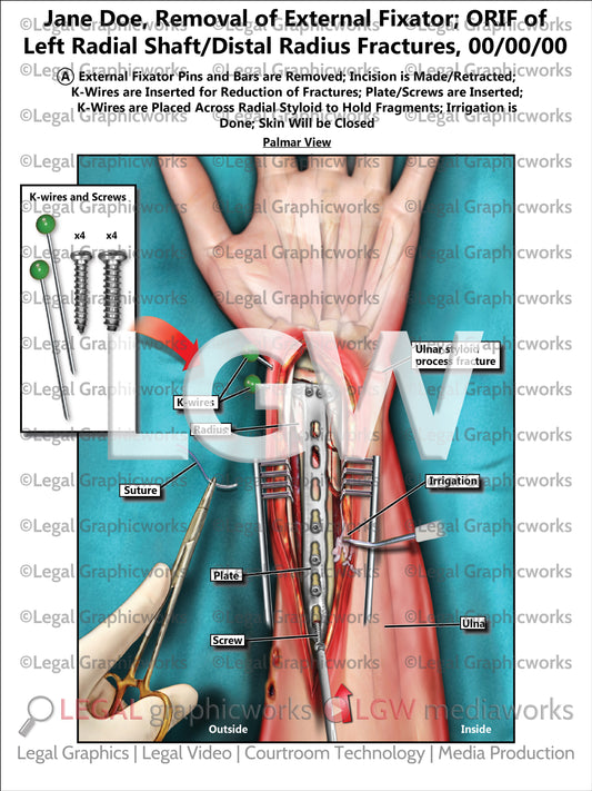 Removal of External Fixator; ORIF of Left Radial Shaft/Distal Radius Fractures