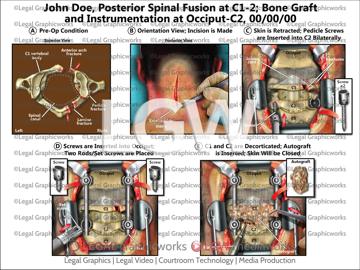 Posterior Spinal Fusion at C1-2; Bone Graft and Instrumentation at Occiput-C2