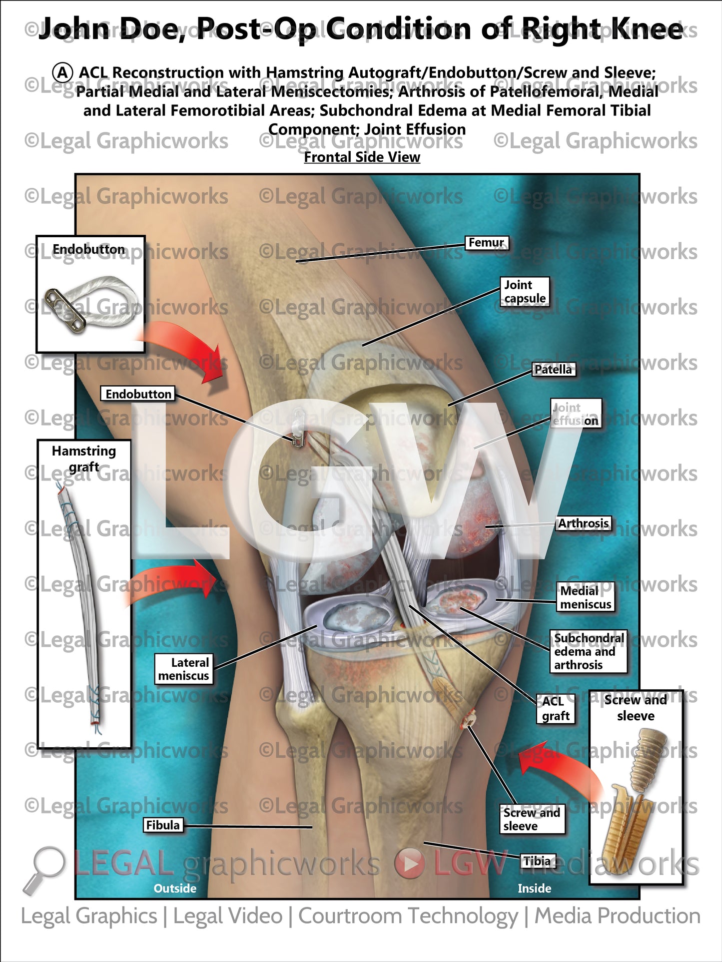 Post-Op Condition of Right Knee