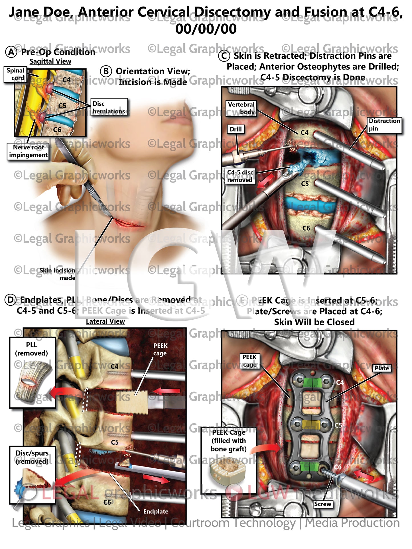 Anterior Cervical Discectomy and Fusion at C4-6