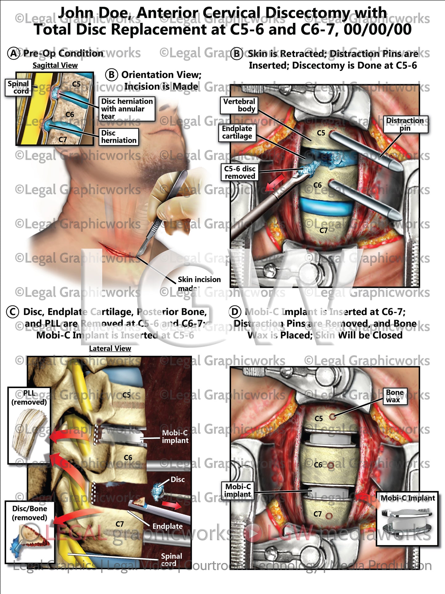 Anterior Cervical Discectomy with Total Disc Replacement at C5-6 and C6-7