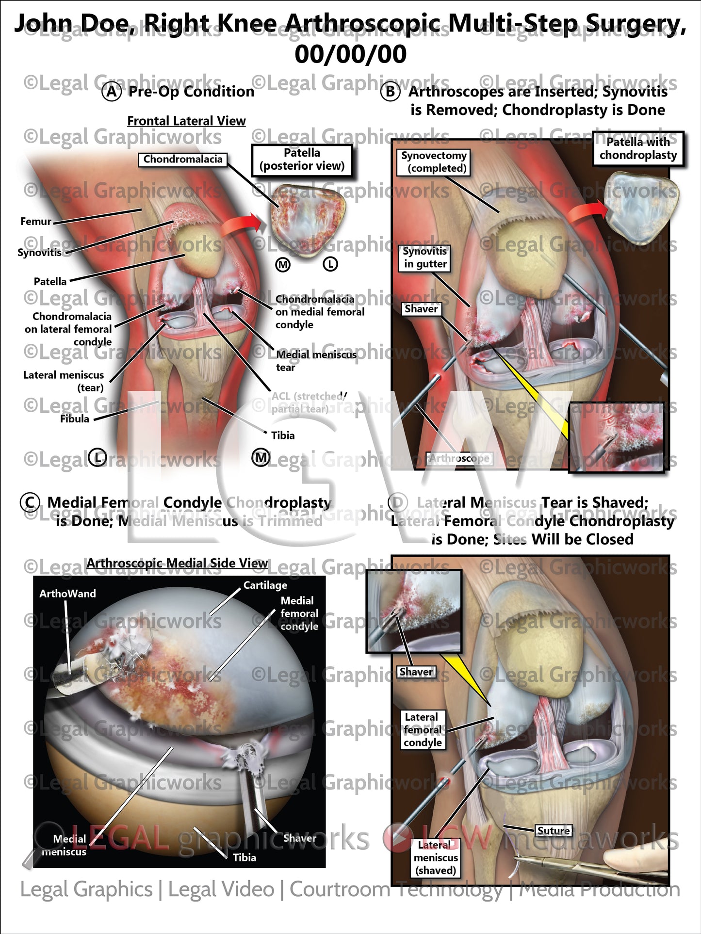 Right Knee Arthroscopic Multi-Step Surgery
