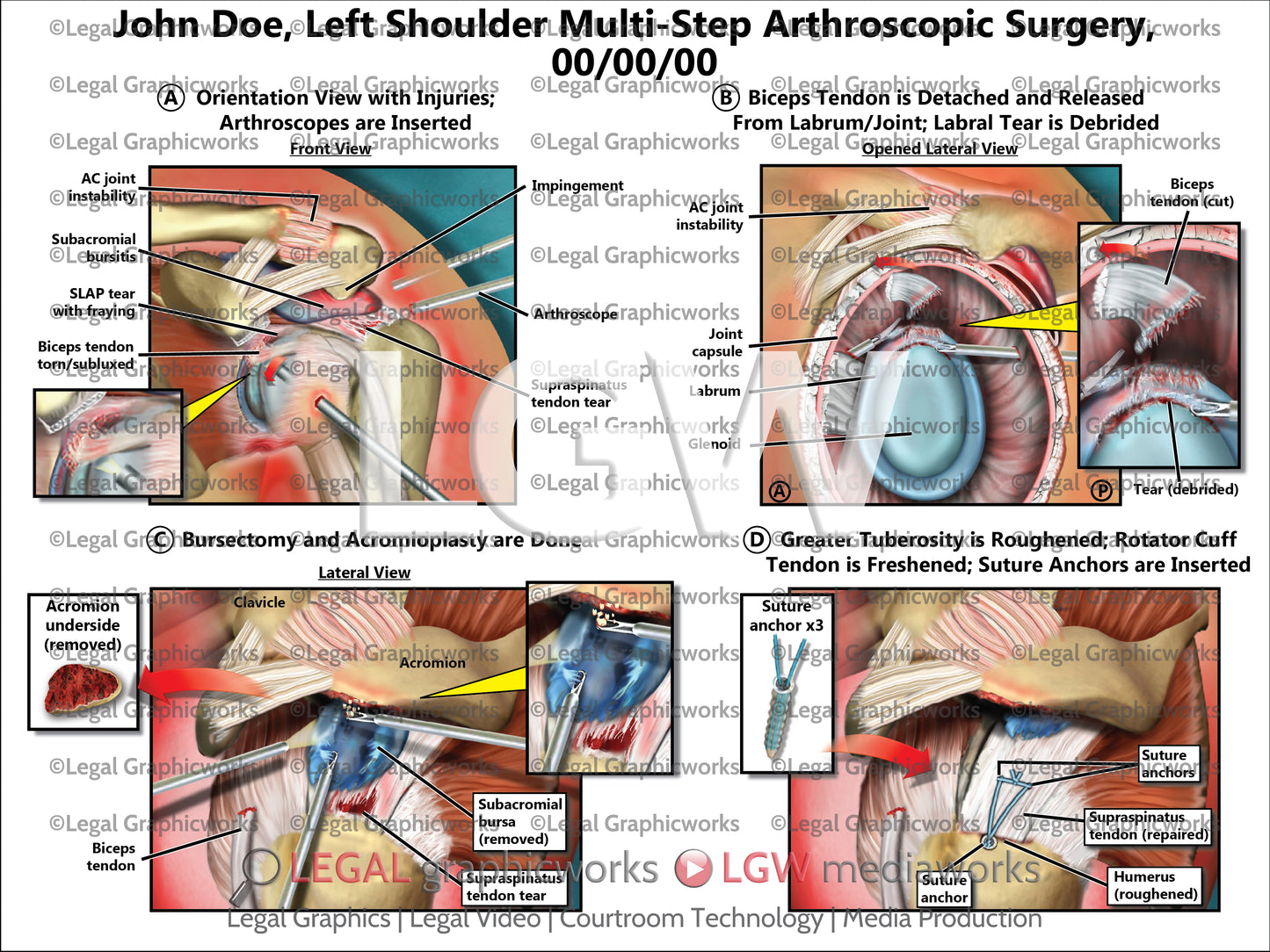 Left Shoulder Multi-Step Arthroscopic Surgery