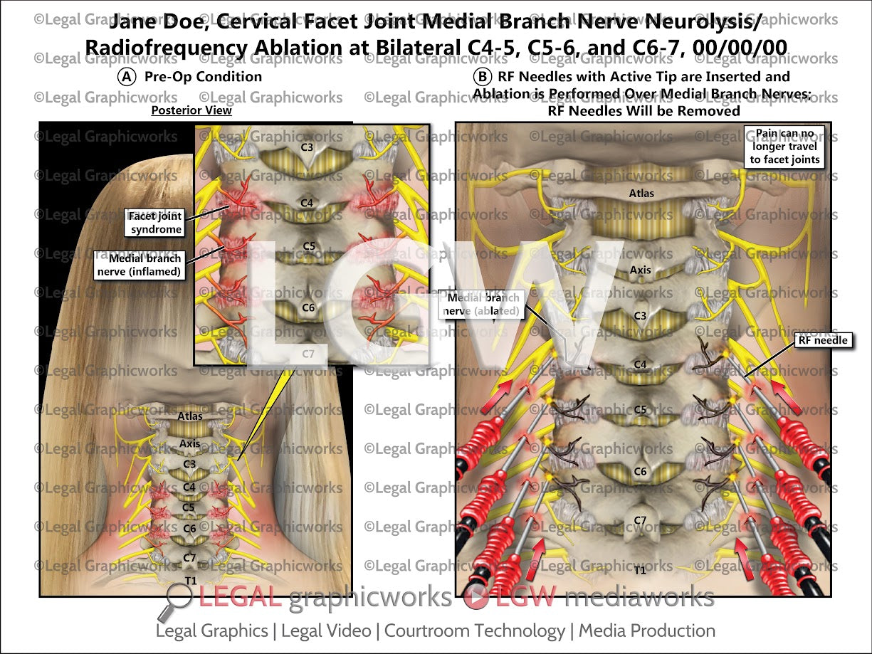 Cervical Facet Joint Medial Branch Nerve Neurolysis/Radiofrequency Ablation at Bilateral C4-5, C5-6, and C6-7