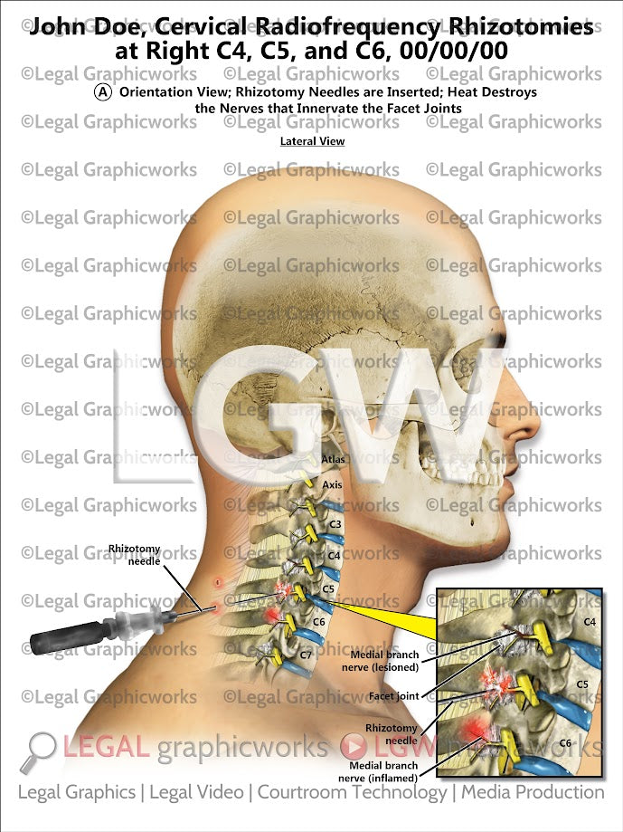 Cervical Radiofrequency Rhizotomies at Right C4, C5, and C6