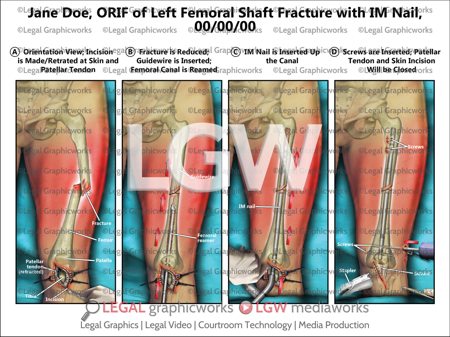 ORIF of Left Femoral Shaft Fracture with IM Nail